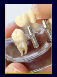 Implantologie und Implanatprothetik