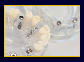 Implantologie und Implanatprothetik