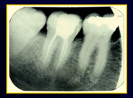 Moderne Wurzelkanalbehandlung